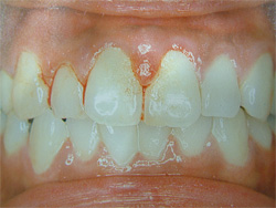 歯周病の原因4