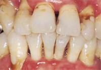 歯周病の進行4