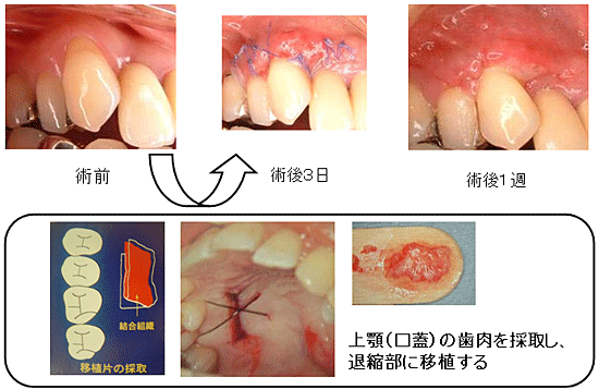 歯周病の治療8