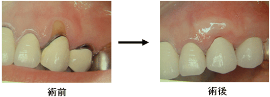 歯周病の治療7