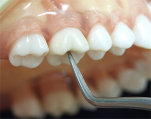 歯周組織精密検査3