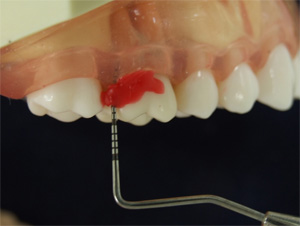 歯周組織精密検査2