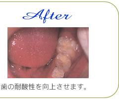 虫歯予防治療2