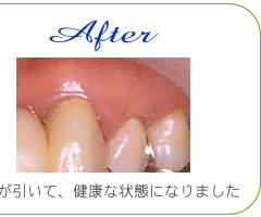 歯肉炎の治療2